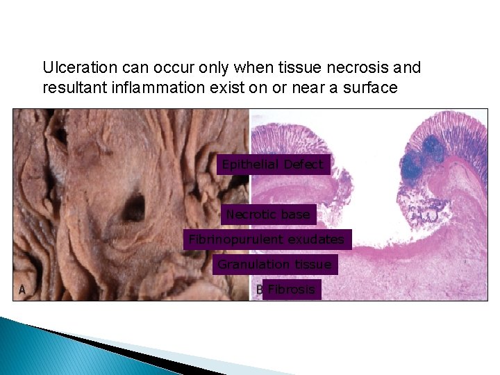 Ulceration can occur only when tissue necrosis and resultant inflammation exist on or near