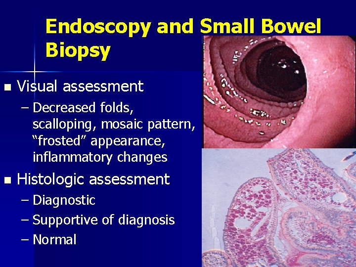 Endoscopy and Small Bowel Biopsy n Visual assessment – Decreased folds, scalloping, mosaic pattern,