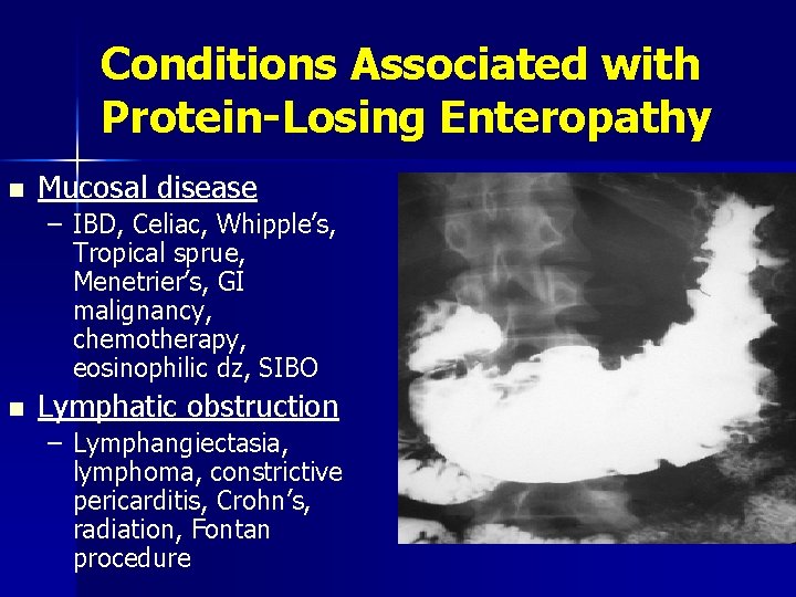 Conditions Associated with Protein-Losing Enteropathy n Mucosal disease – IBD, Celiac, Whipple’s, Tropical sprue,