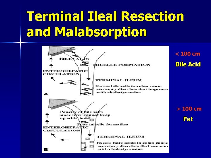 Terminal Ileal Resection and Malabsorption < 100 cm Bile Acid > 100 cm Fat
