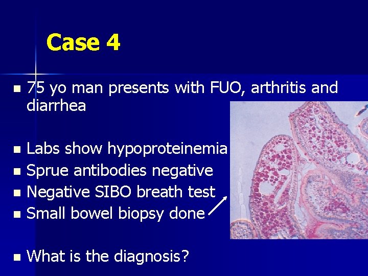 Case 4 n 75 yo man presents with FUO, arthritis and diarrhea Labs show