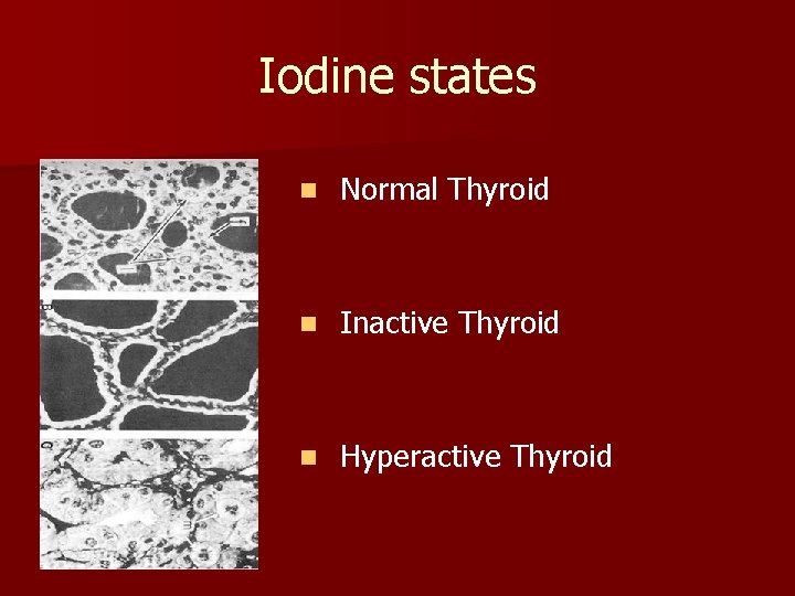 Iodine states n Normal Thyroid n Inactive Thyroid n Hyperactive Thyroid 