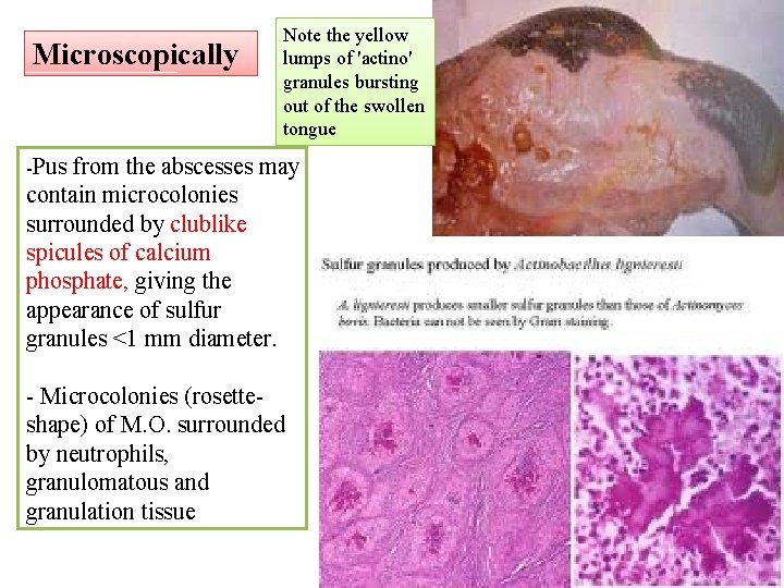 Microscopically Note the yellow lumps of 'actino' granules bursting out of the swollen tongue