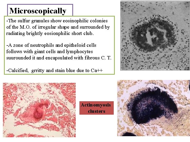 Microscopically -The sulfur granules show eosinophilic colonies of the M. O. of irregular shape