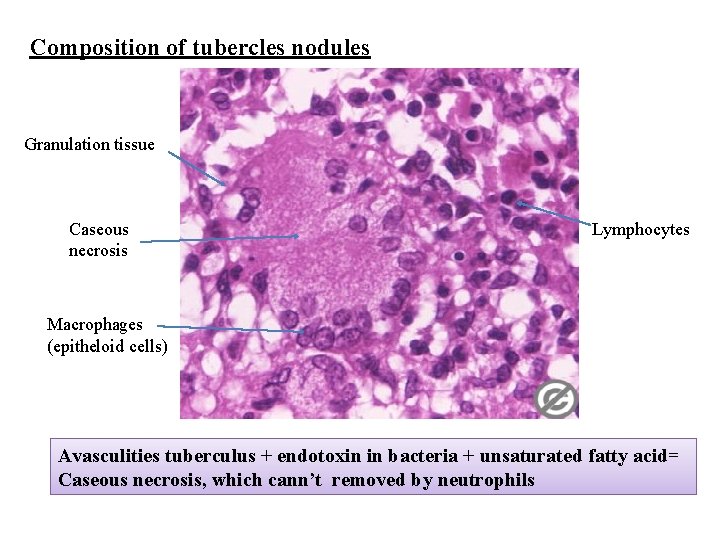 Composition of tubercles nodules Granulation tissue Caseous necrosis Lymphocytes Macrophages (epitheloid cells) Avasculities tuberculus