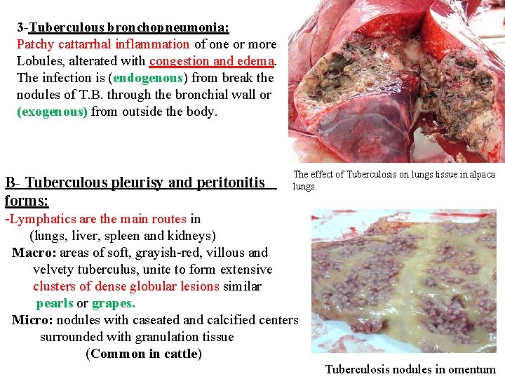 3 -Tuberculous bronchopneumonia: Patchy cattarrhal inflammation of one or more Lobules, alterated with congestion