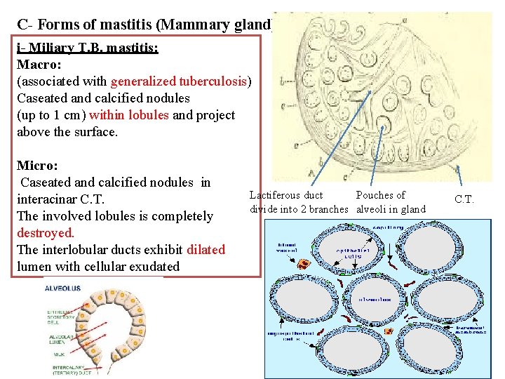 C- Forms of mastitis (Mammary gland) i- Miliary T. B. mastitis: Macro: (associated with