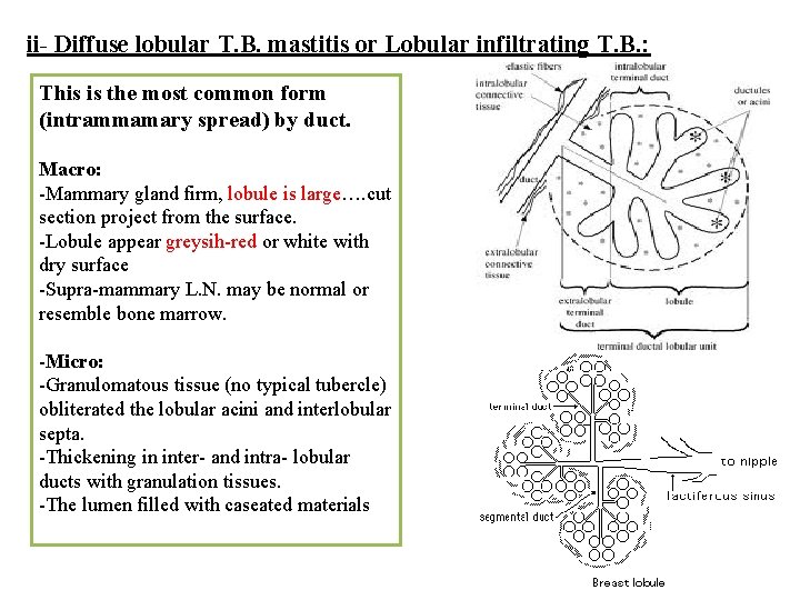 ii- Diffuse lobular T. B. mastitis or Lobular infiltrating T. B. : This is