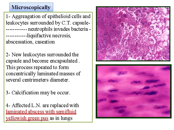 Microscopically 1 - Aggreagation of epithelioid cells and leukocytes surrounded by C. T. capsule------