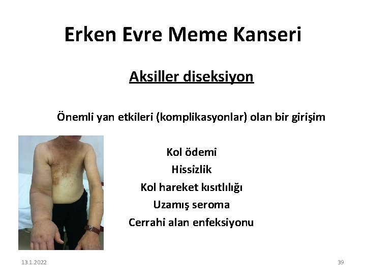 Erken Evre Meme Kanseri Aksiller diseksiyon Önemli yan etkileri (komplikasyonlar) olan bir girişim Kol