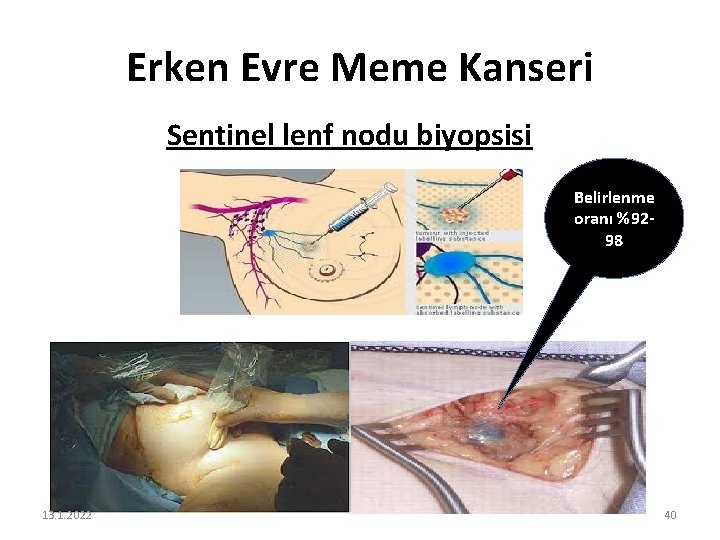 Erken Evre Meme Kanseri Sentinel lenf nodu biyopsisi Belirlenme oranı %9298 13. 1. 2022