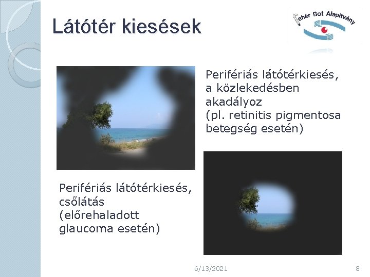 Látótér kiesések Perifériás látótérkiesés, a közlekedésben akadályoz (pl. retinitis pigmentosa betegség esetén) Perifériás látótérkiesés,