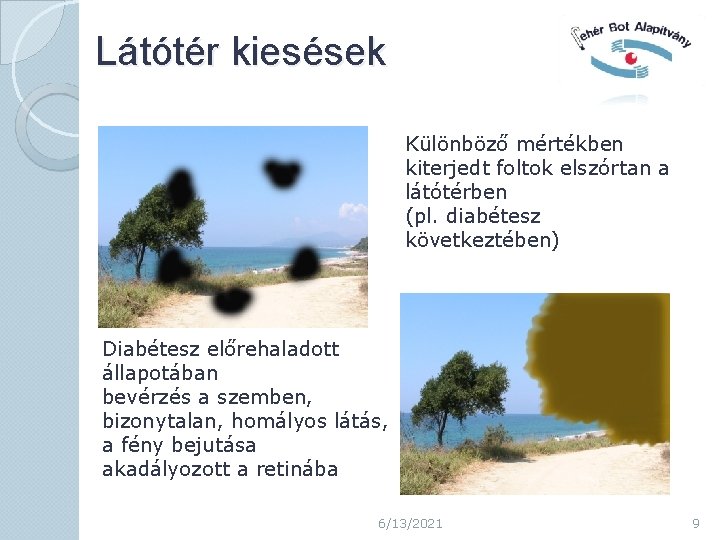 Látótér kiesések Különböző mértékben kiterjedt foltok elszórtan a látótérben (pl. diabétesz következtében) Diabétesz előrehaladott