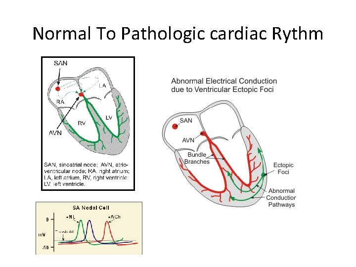 Normal To Pathologic cardiac Rythm 