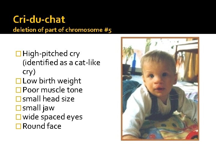 Cri-du-chat deletion of part of chromosome #5 � High-pitched cry (identified as a cat-like