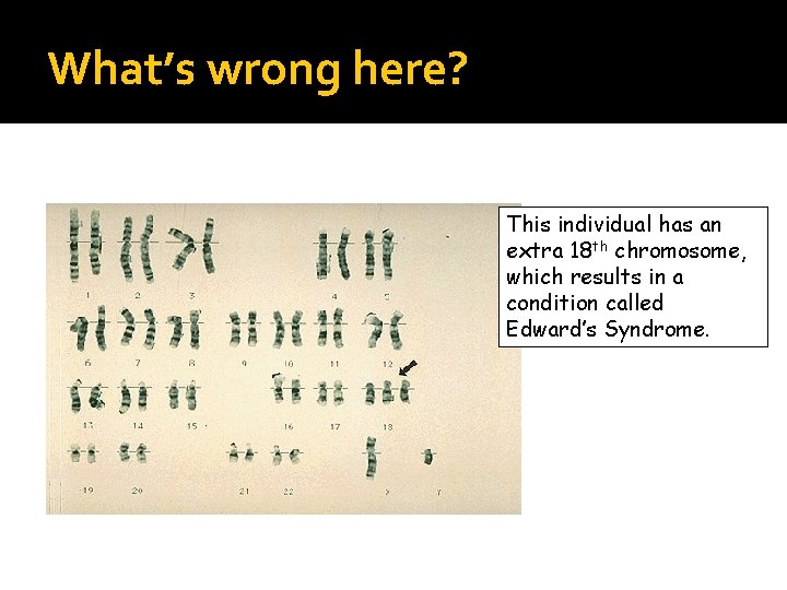 What’s wrong here? This individual has an extra 18 th chromosome, which results in