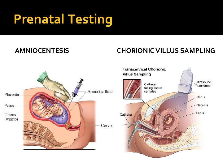 Prenatal Testing AMNIOCENTESIS CHORIONIC VILLUS SAMPLING 