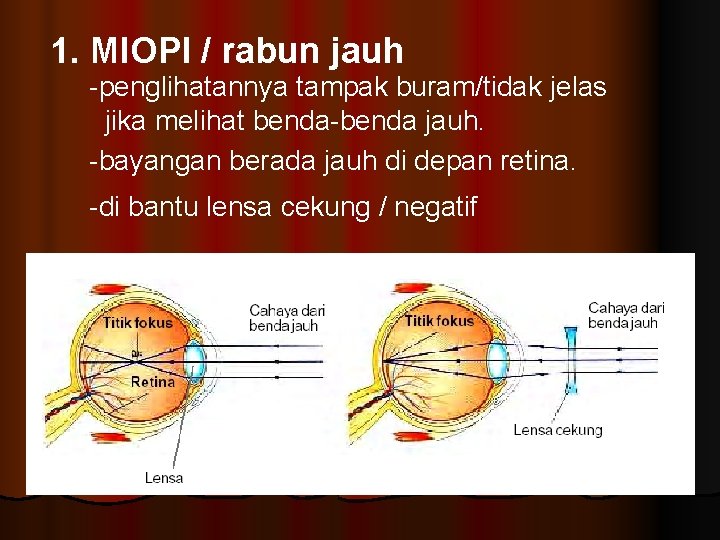 1. MIOPI / rabun jauh -penglihatannya tampak buram/tidak jelas jika melihat benda-benda jauh. -bayangan