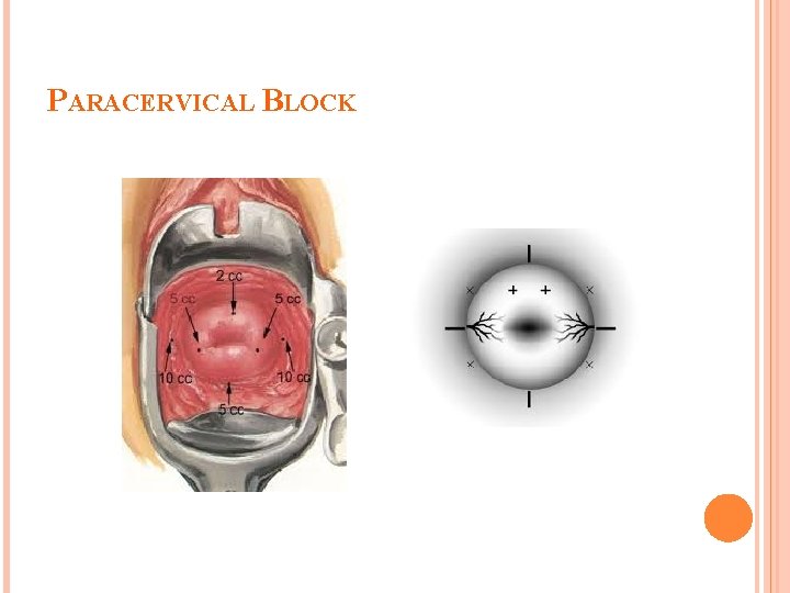 PARACERVICAL BLOCK 