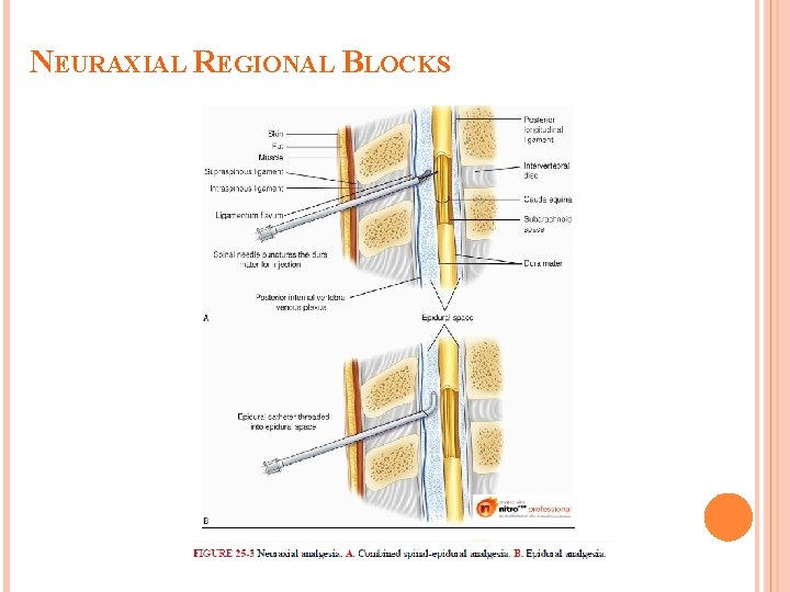 NEURAXIAL REGIONAL BLOCKS 
