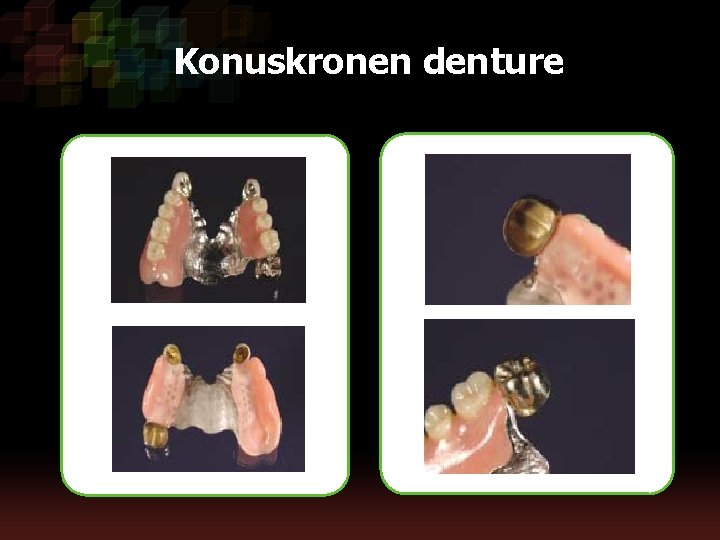 Konuskronen denture 