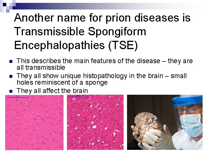 Another name for prion diseases is Transmissible Spongiform Encephalopathies (TSE) n n n This