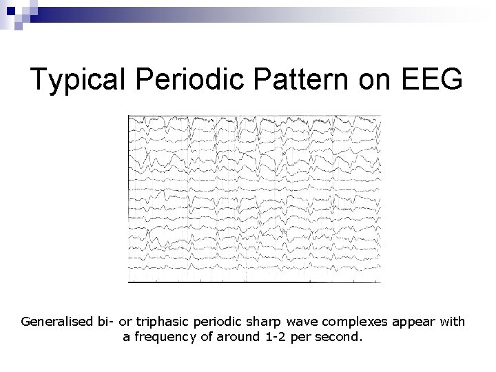 Typical Periodic Pattern on EEG Generalised bi- or triphasic periodic sharp wave complexes appear