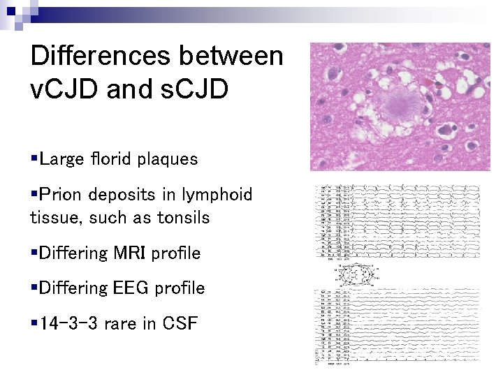 Differences between v. CJD and s. CJD §Large florid plaques §Prion deposits in lymphoid