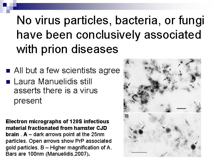 No virus particles, bacteria, or fungi have been conclusively associated with prion diseases n