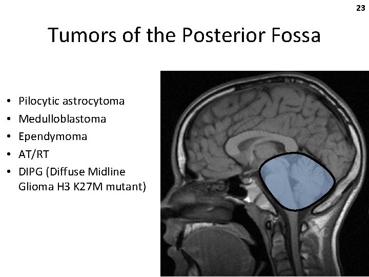 23 Tumors of the Posterior Fossa • • • Pilocytic astrocytoma Medulloblastoma Ependymoma AT/RT
