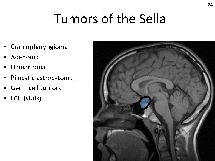 24 Tumors of the Sella • • • Craniopharyngioma Adenoma Hamartoma Pilocytic astrocytoma Germ