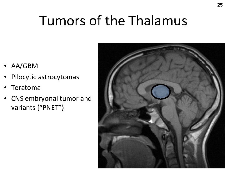 25 Tumors of the Thalamus • • AA/GBM Pilocytic astrocytomas Teratoma CNS embryonal tumor