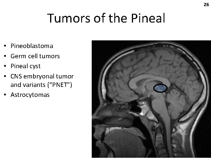 26 Tumors of the Pineal Pineoblastoma Germ cell tumors Pineal cyst CNS embryonal tumor