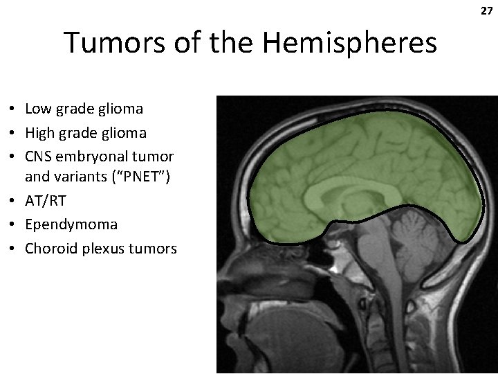 27 Tumors of the Hemispheres • Low grade glioma • High grade glioma •