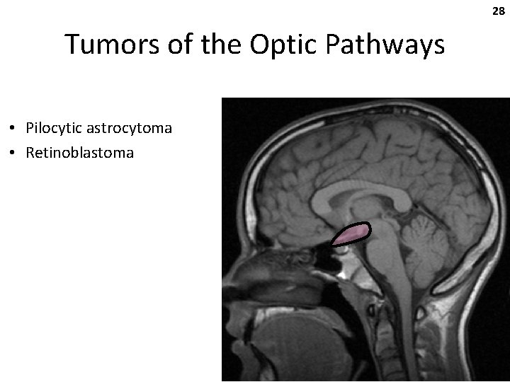 28 Tumors of the Optic Pathways • Pilocytic astrocytoma • Retinoblastoma 