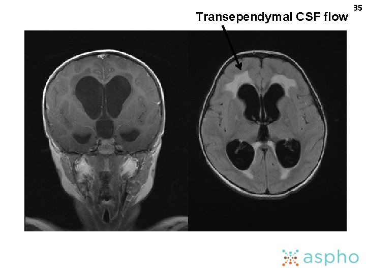 Transependymal CSF flow 35 