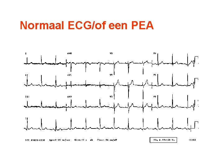 Europese Reanimatieraad Basale reanimatie Basic Life Support BLSAED