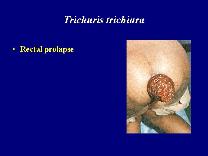 Trichuris trichiura • Rectal prolapse 