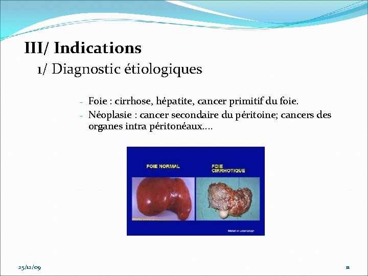 III/ Indications 1/ Diagnostic étiologiques – – 25/12/09 Foie : cirrhose, hépatite, cancer primitif