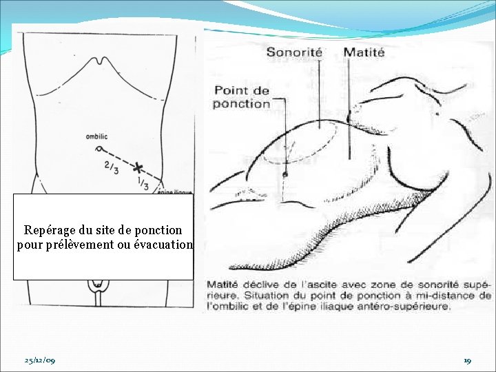 Repérage du site de ponction pour prélèvement ou évacuation 25/12/09 19 