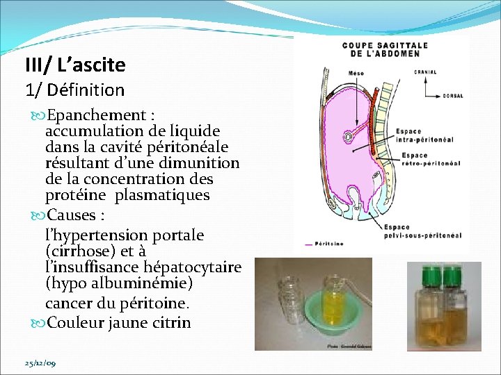 III/ L’ascite 1/ Définition Epanchement : accumulation de liquide dans la cavité péritonéale résultant
