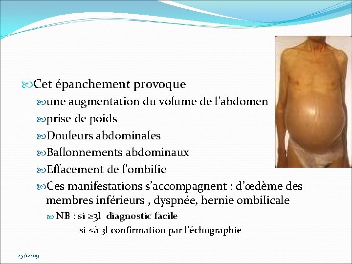  Cet épanchement provoque une augmentation du volume de l’abdomen prise de poids Douleurs