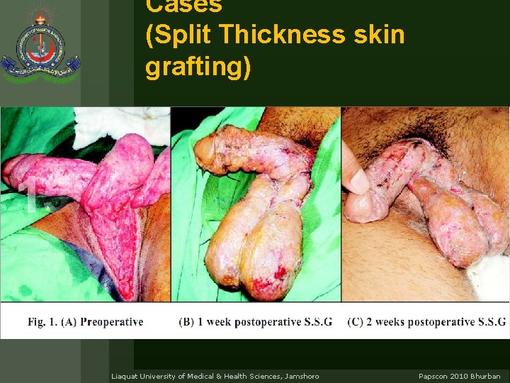 Cases (Split Thickness skin grafting) Liaquat University of Medical & Health Sciences, Jamshoro Papscon