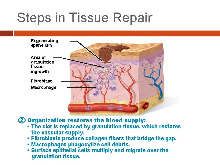 Steps in Tissue Repair Regenerating epithelium Area of granulation tissue ingrowth Fibroblast Macrophage 2 Steps in Tissue Repair Regenerating epithelium Area of granulation tissue ingrowth Fibroblast Macrophage 2