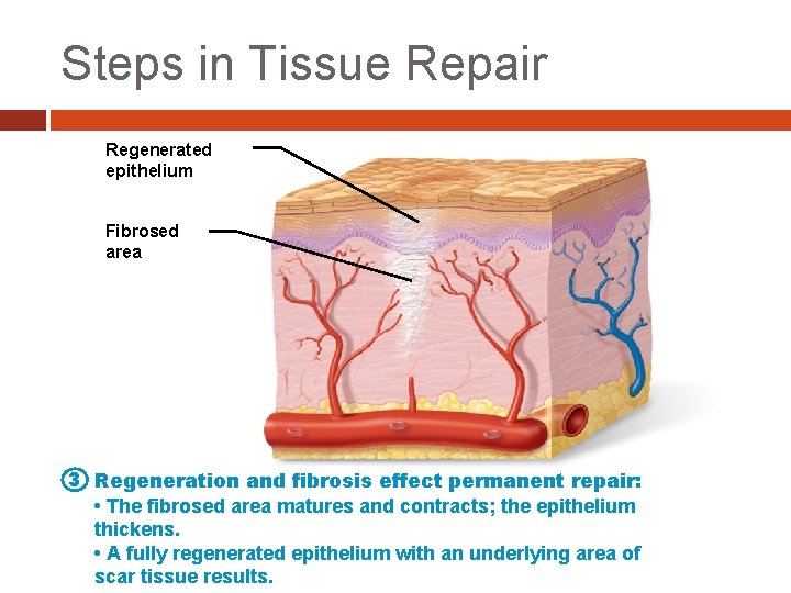 Steps in Tissue Repair Regenerated epithelium Fibrosed area 3 Regeneration and fibrosis effect permanent