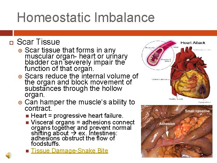 Homeostatic Imbalance Scar Tissue Scar tissue that forms in any muscular organ- heart or