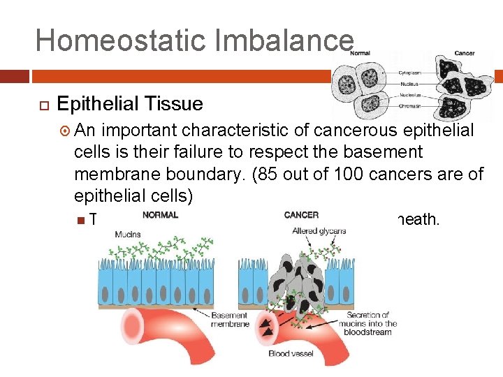 Homeostatic Imbalance Epithelial Tissue An important characteristic of cancerous epithelial cells is their failure Homeostatic Imbalance Epithelial Tissue An important characteristic of cancerous epithelial cells is their failure