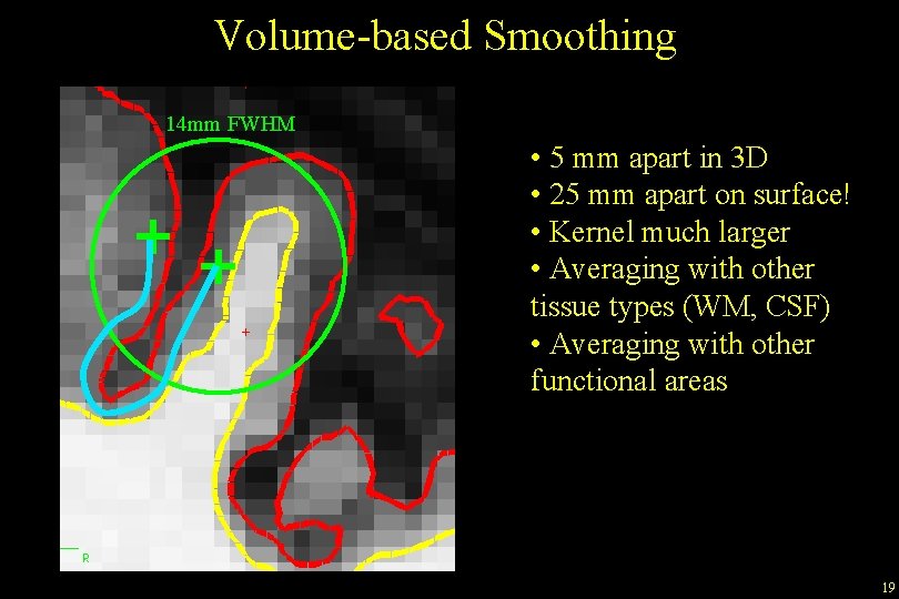 Volume-based Smoothing 14 mm FWHM • 5 mm apart in 3 D • 25