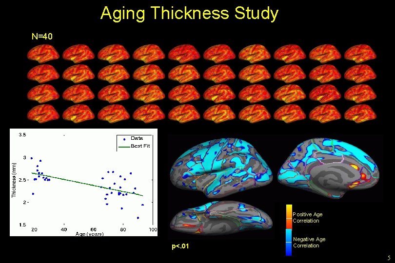 Aging Thickness Study N=40 Positive Age Correlation p<. 01 Negative Age Correlation 5 