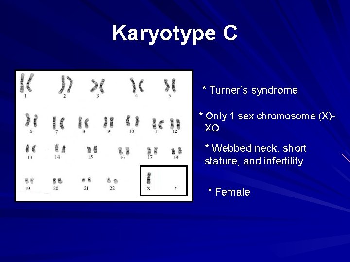 Karyotype C * Turner’s syndrome * Only 1 sex chromosome (X)XO * Webbed neck,